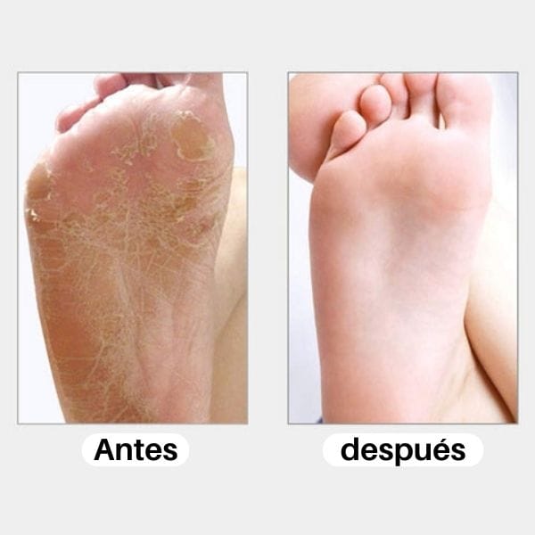 SOFT FEET™ Removedor de asperezas y callos para pies (Eléctrico)